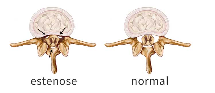 Estenose Lombar - Tratamentos e Causas – NeurOrtho Spine Center