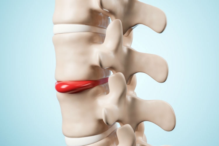 Hérnia de Disco - Sintomas e Tratamentos – NeurOrtho Spine Center